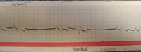  ECG or EKG