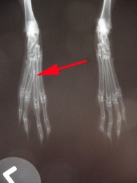 fractures fractures